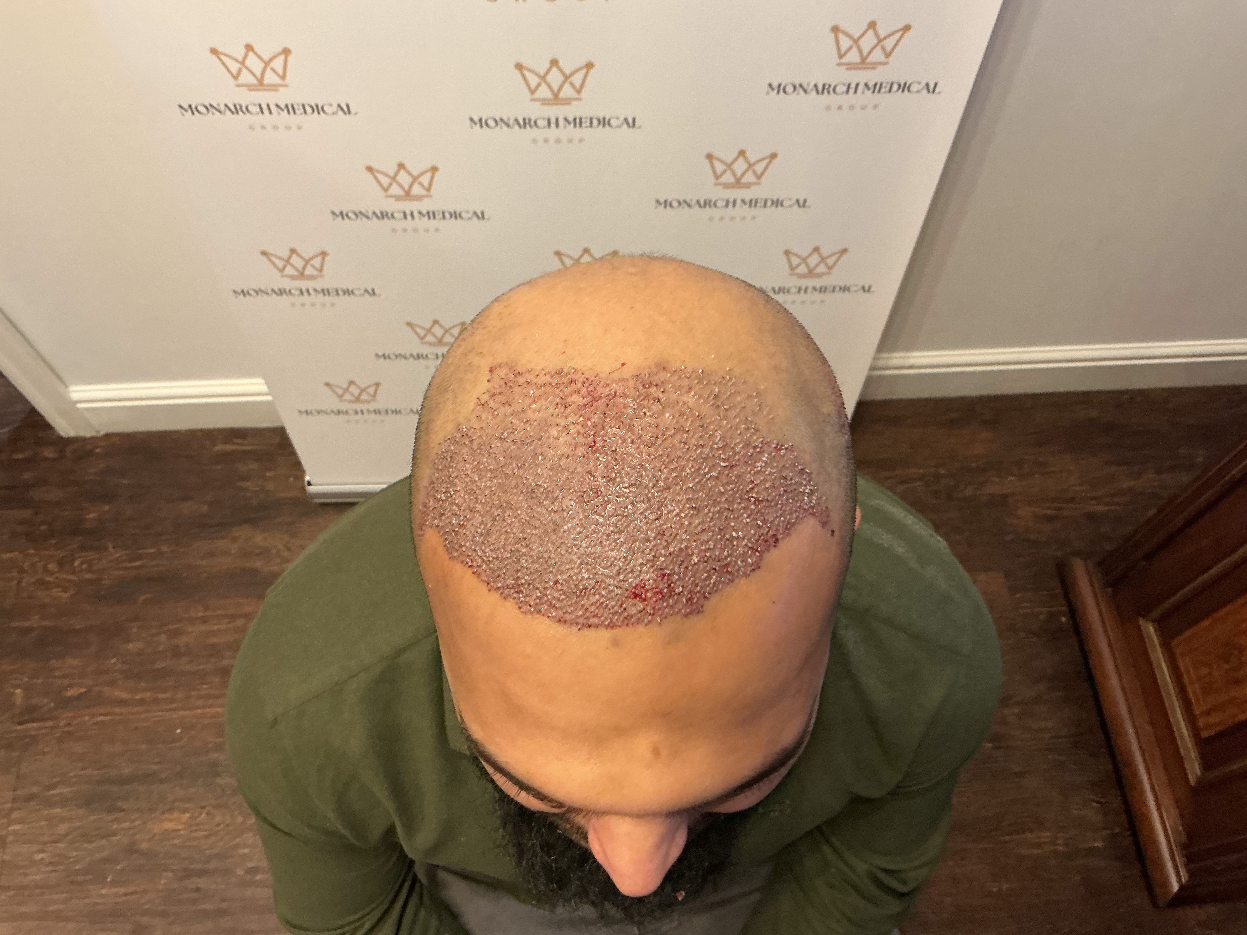 Norwood 7 hair transplant — Hussain result photo 5